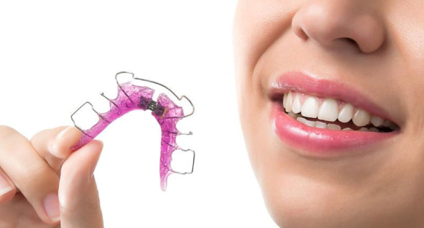 clear retainer cost