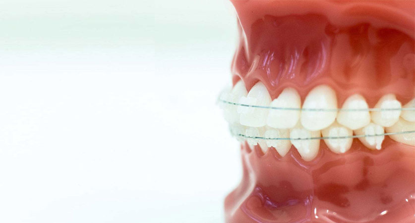 clear braces near me