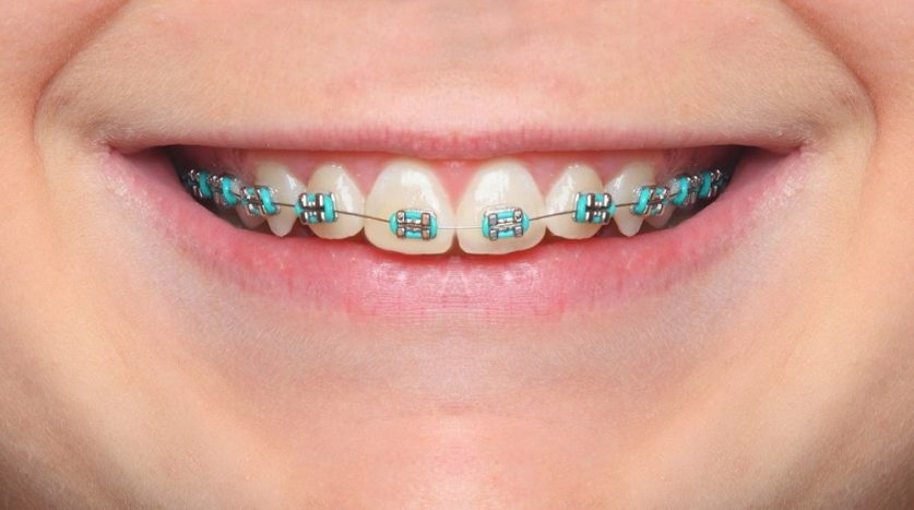 braces colors