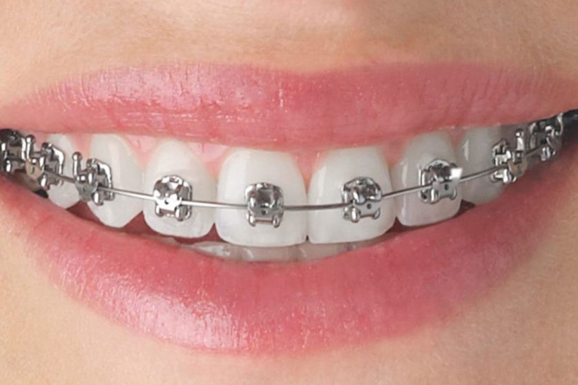affordable braces Miami