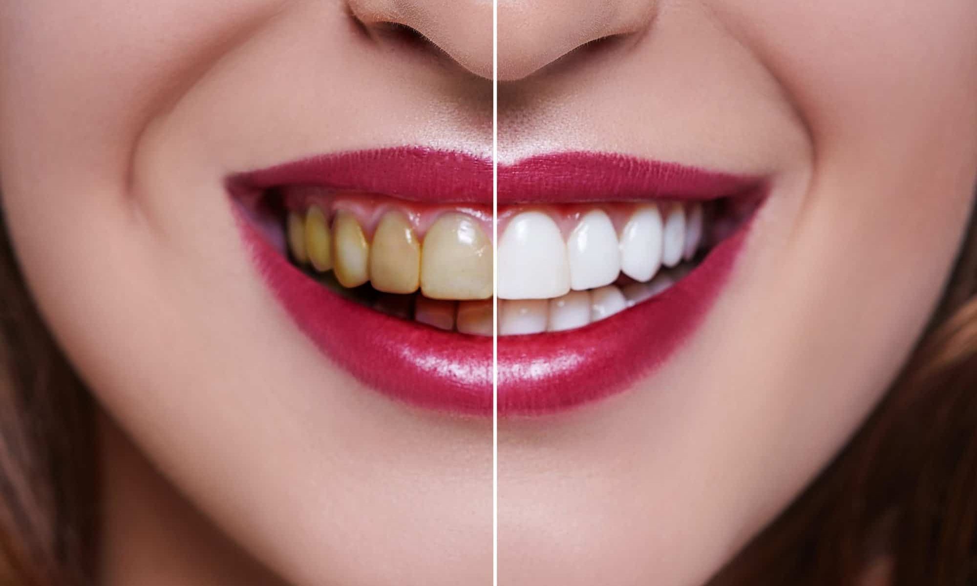 Teeth Whitening