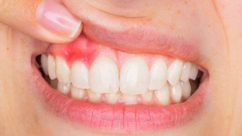 Tooth Abscess