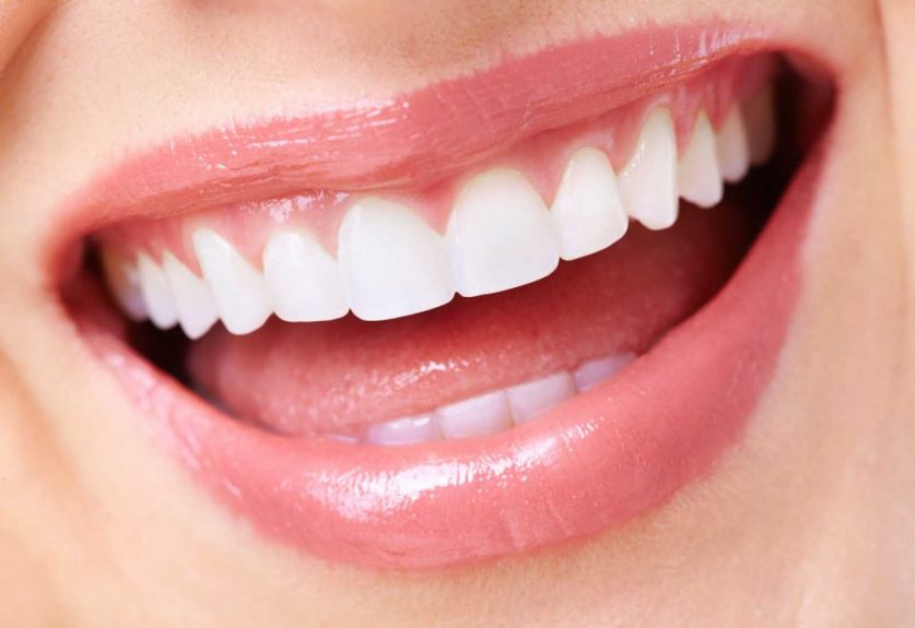 Porcelain Veneers