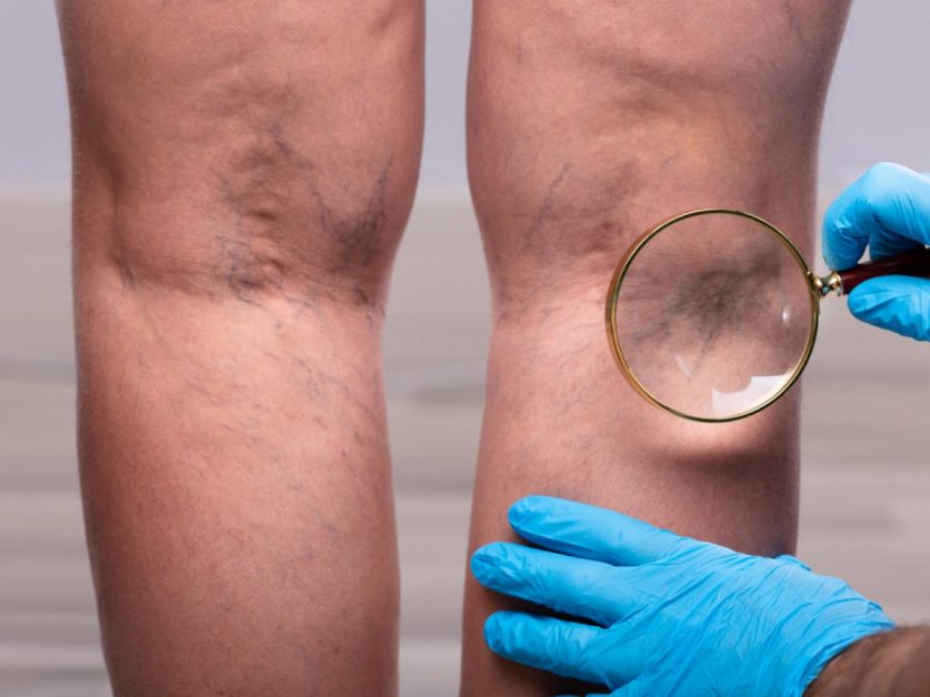 Varicose Vein Treatment