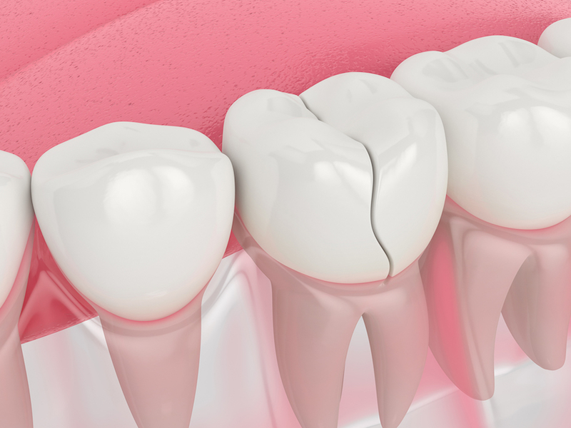 Cracked Teeth