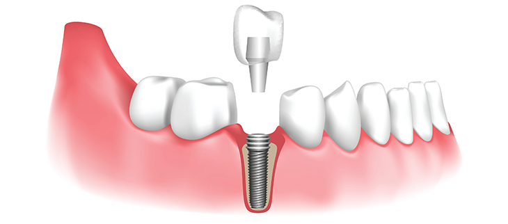 dental implants houston