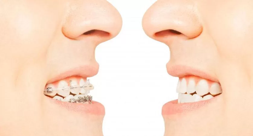 Teeth Alignment Procedure
