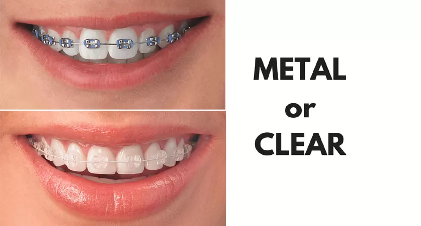 Metal or Invisible Braces