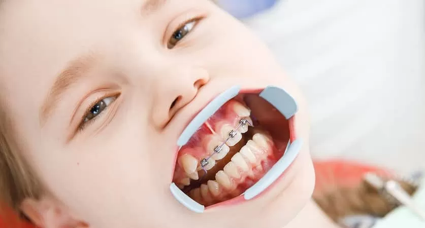 kids teeth braces