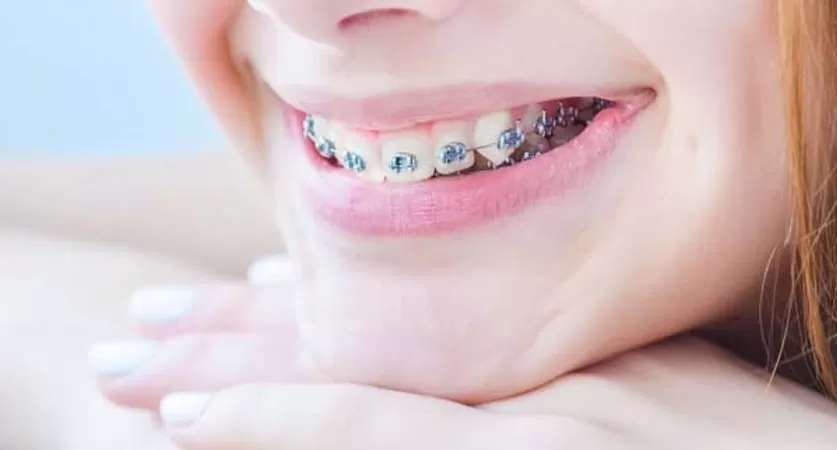 teeth straightening
