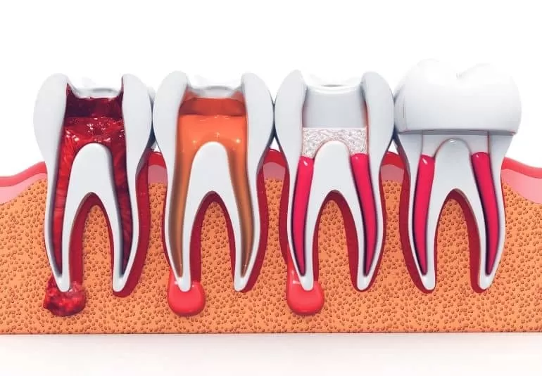 Types of Root Canals