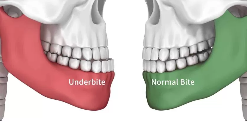 underbite braces