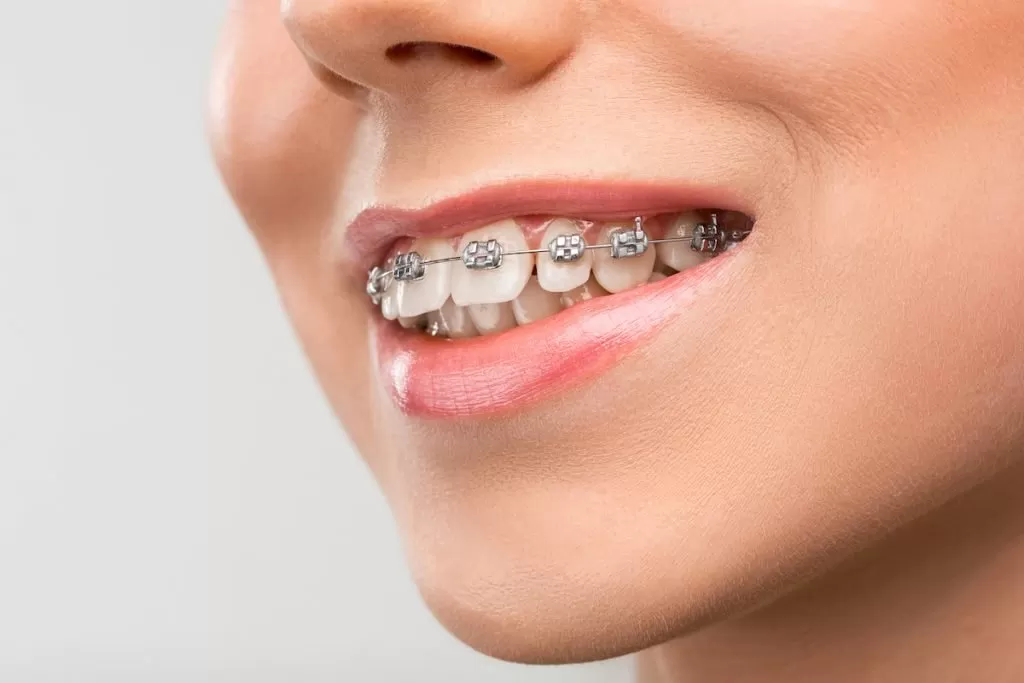 braces with missing teeth