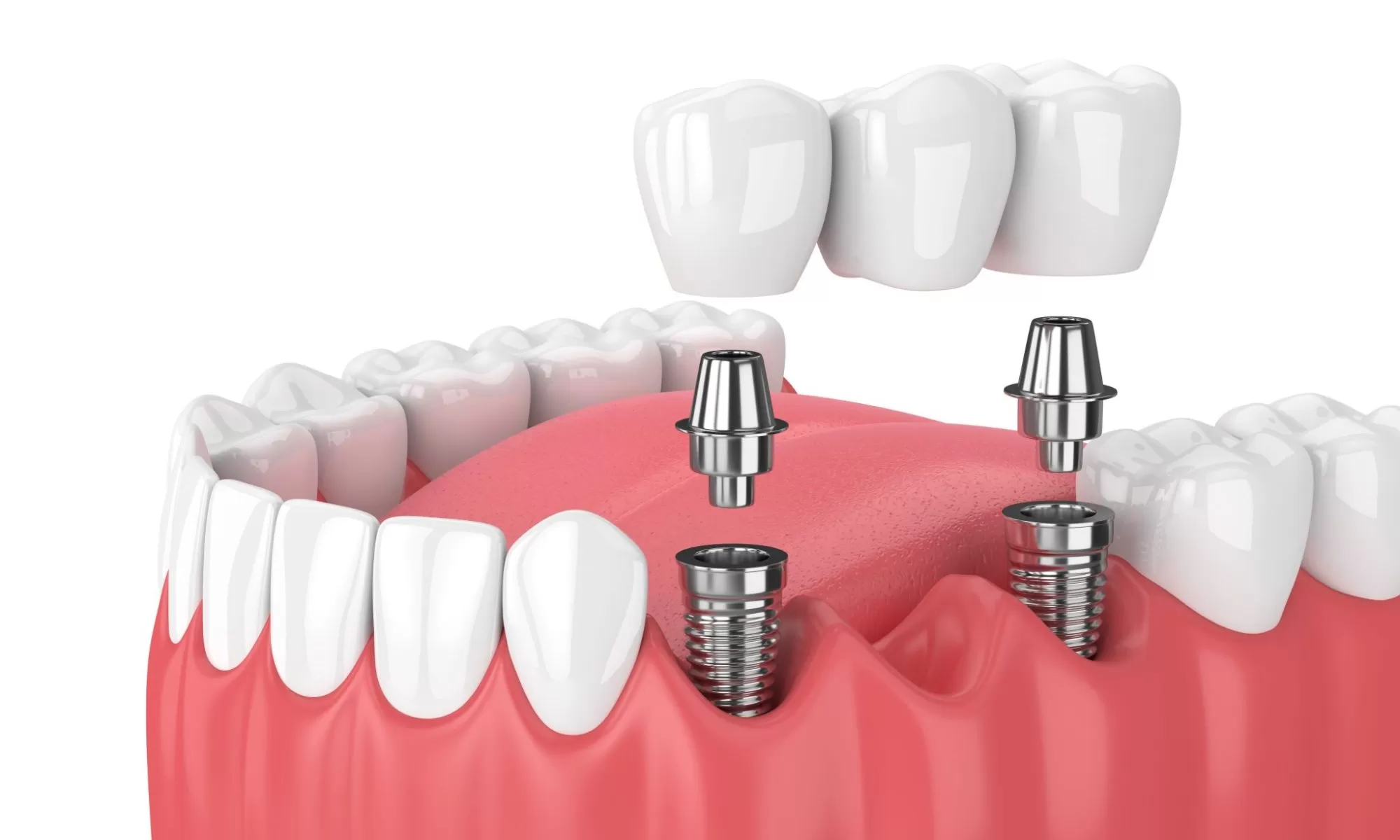 dental implants houston